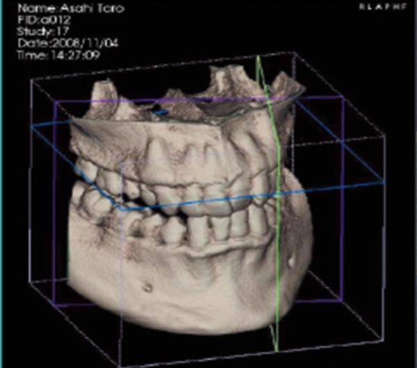 3次元CTにより詳細な診断が可能です。インプラント、歯周病、根幹治療(歯の根の治療)、顎関節症、矯正などの治療時に有効です。